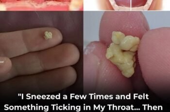 Causes of White or Yellow Balls on the Tonsils