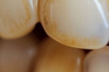 Dentists Won’t Tell You This: Natural Ways to Remove Tartar and Whiten Teeth at Home