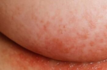 An itchy rash keeps flaring up under my breasts in winter, but my doctor isn’t available right now. What can I do today?
