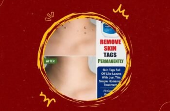 Homemade Skin Tag Removal Remedy