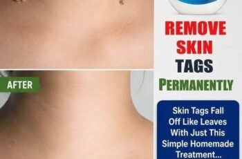 homemade skin tag removal remedy